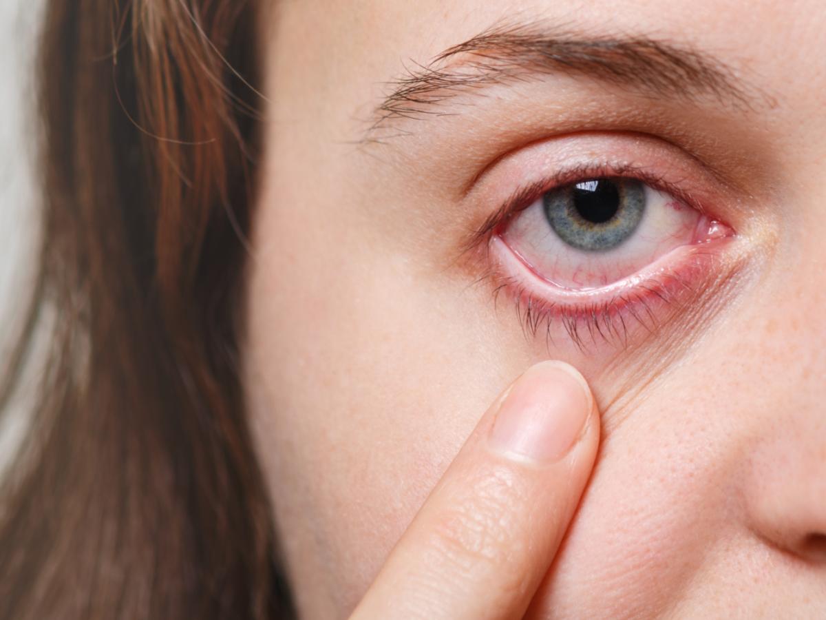 inflammation of the eyelids