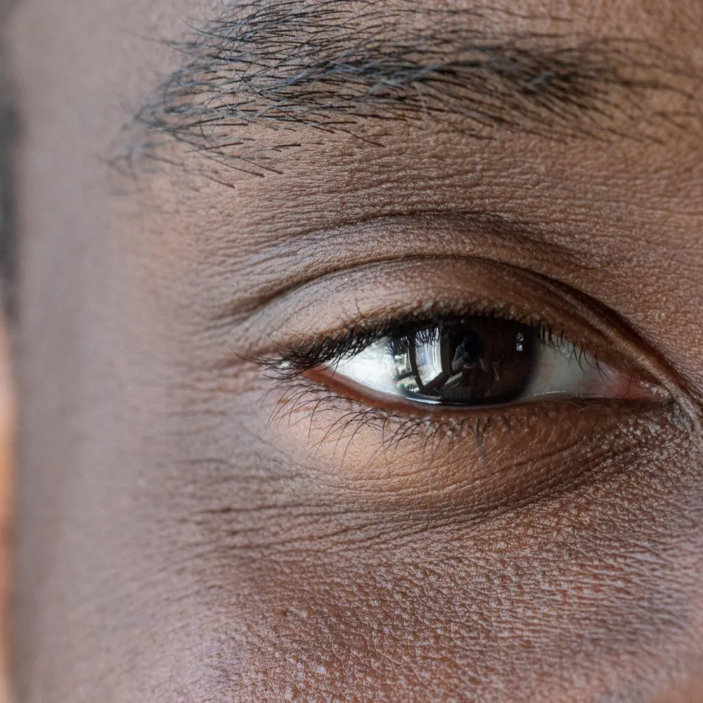 Scleral Contact Lenses