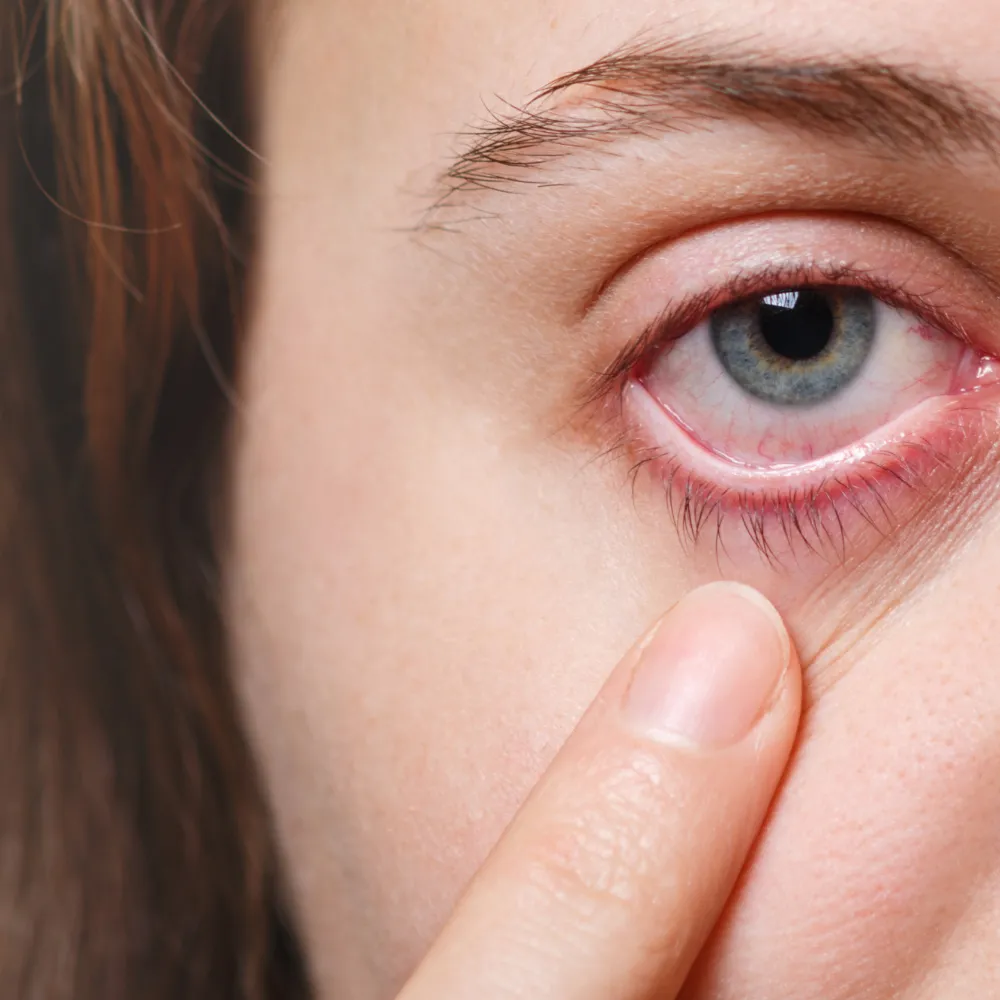 inflammation of the eyelids